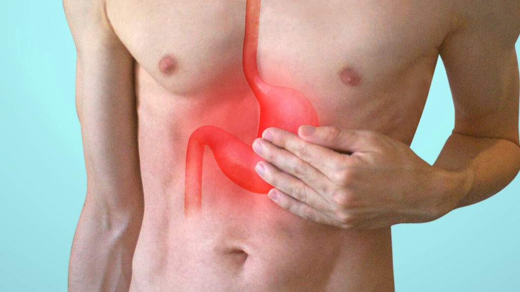 Acid Reflux